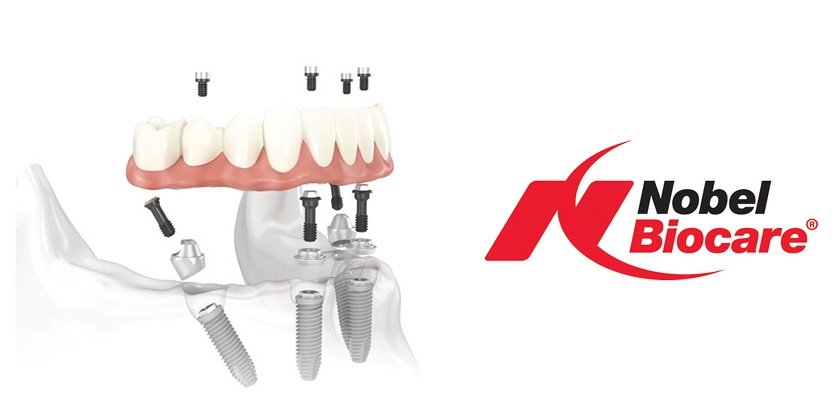 Reduce chair time with the Multi-unit Abutment Plus