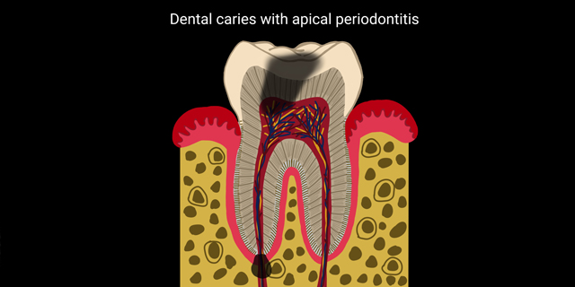 Perio – Cardio Disease Link
