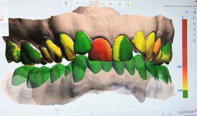 3Shape TRIOS intraoral scanner